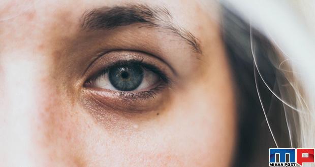 بهترین راهکارها برای رفع سیاهی زیر چشم و بررسی دلایل آن 1 رفع سیاهی زیر چشم