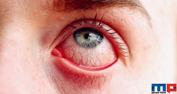 درمان قرمزی چشم با روش های ساده و خانگی 5 درمان قرمزی چشم