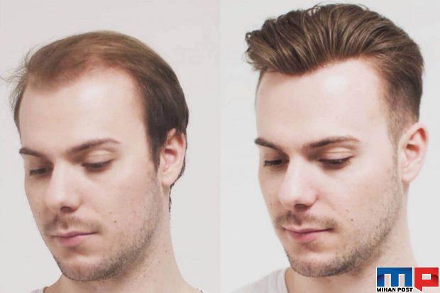 دلایل ریزش مو و درمان ریزش موی هورمونی 3 ریزش مو