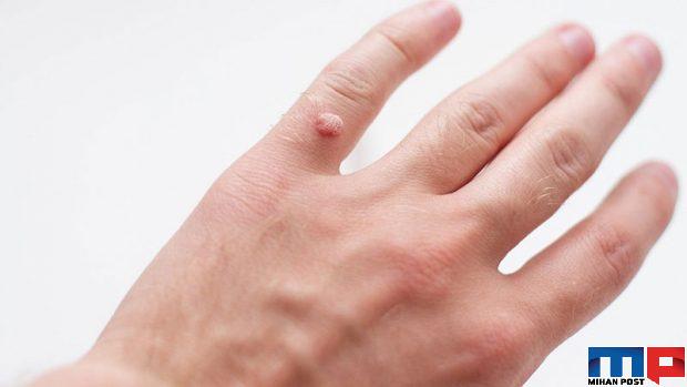 کندن زگیل های کوچک با استفاده از یک روش خانگی 2 کندن زگیل های کوچک