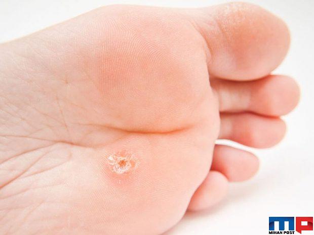 کندن زگیل های کوچک با استفاده از یک روش خانگی 3 کندن زگیل های کوچک