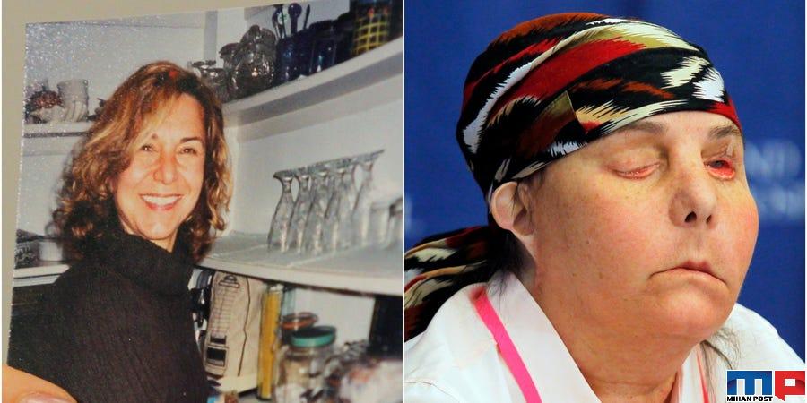 عمل پیوند صورت برای دومین بار برای کارمن تارلتون انجام شد 11 عمل پیوند صورت