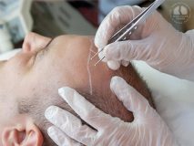 عوارض حاصل از کاشت مو چیست؟