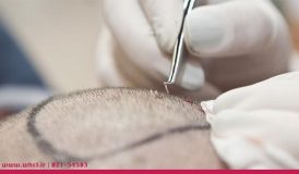 عوارض حاصل از کاشت مو چیست؟