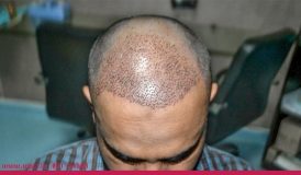 عوارض حاصل از کاشت مو چیست؟