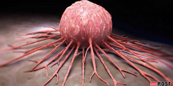 پیشگیری از سرطان با چه راهکارهایی امکان پذیر است؟ 6 پیشگیری از سرطان