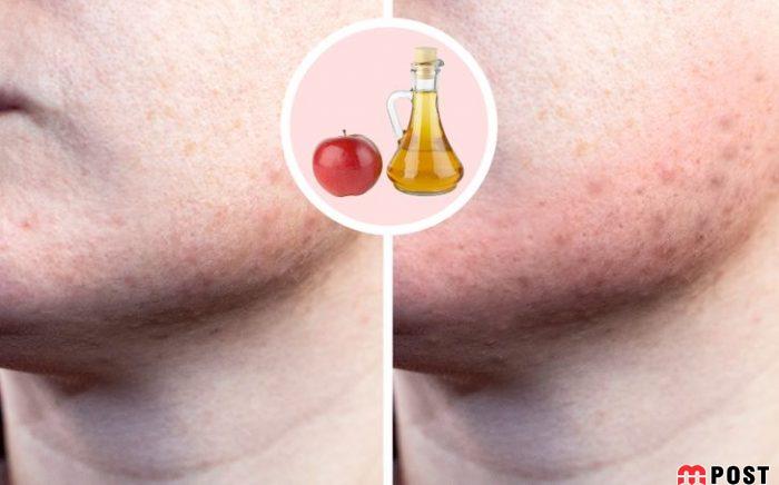 استفاده افراطی از مواد طبیعی مراقبت از پوست چه عوارضی دارد؟ 8 مواد طبیعی مراقبت از پوست