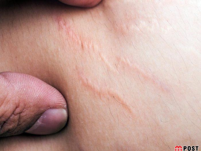 رفع ترک های پوستی