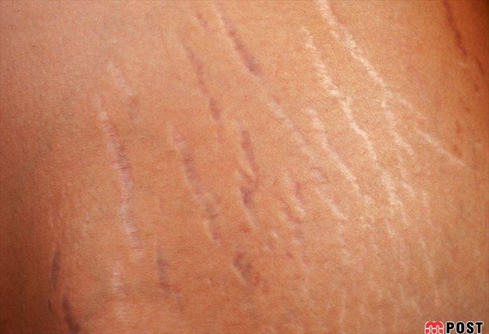 رفع ترک های پوستی با استفاده از چند روش موثر پزشکی 4 رفع ترک های پوستی