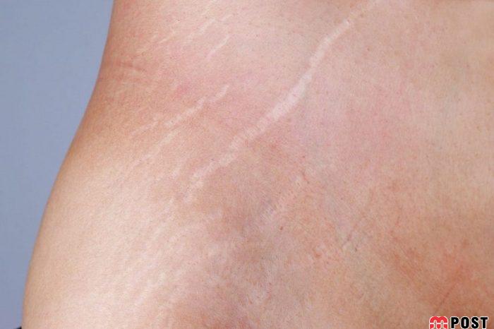 رفع ترک های پوستی با استفاده از چند روش موثر پزشکی 2 رفع ترک های پوستی