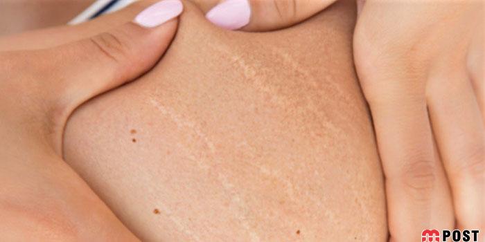 رفع ترک های پوستی با استفاده از چند روش موثر پزشکی 4 رفع ترک های پوستی