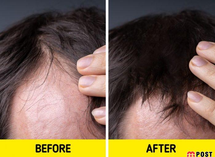 افزایش رشد مو