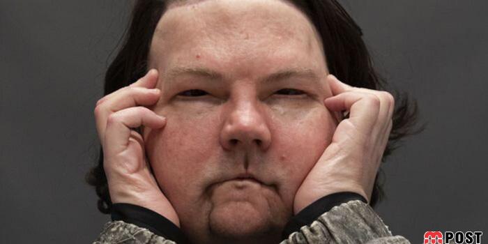 جو دیمئو تحت جراحی پیوند همزمان صورت و دست قرار گرفت 5 جو دیمئو