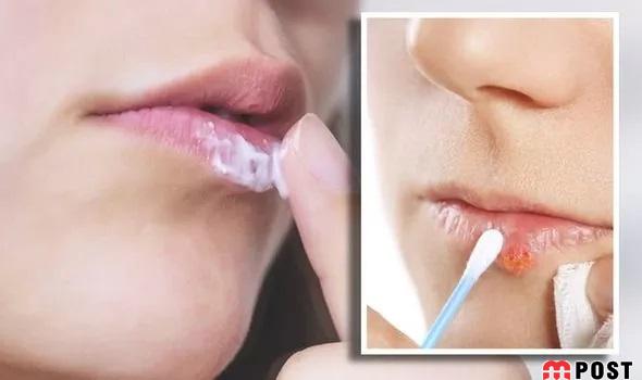 درمان تبخال با ساده ترین و سریع ترین راهکارهای ممکن 3 درمان تبخال