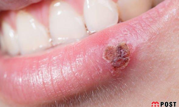 درمان تبخال با ساده ترین و سریع ترین راهکارهای ممکن 4 درمان تبخال