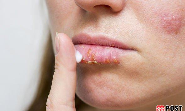 درمان تبخال با ساده ترین و سریع ترین راهکارهای ممکن 2 درمان تبخال