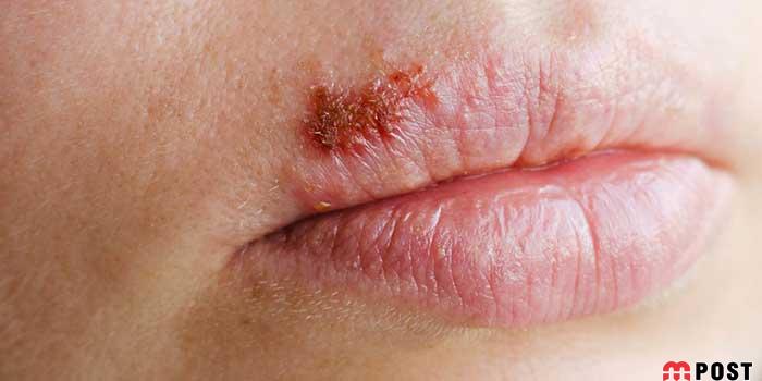 درمان تبخال با ساده ترین و سریع ترین راهکارهای ممکن 9 درمان تبخال