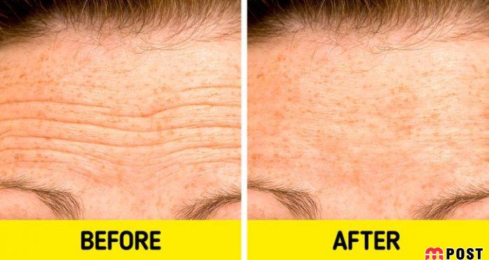 چین و چروک پیشانی را با ۵ روش ساده و موثر از بین ببرید 3 چین و چروک پیشانی