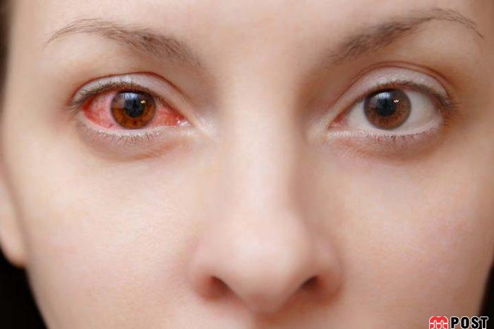 خواص تخم گشنیز برای سلامتی پوست و مو و درمان انواع بیماری ها 6 خواص تخم گشنیز