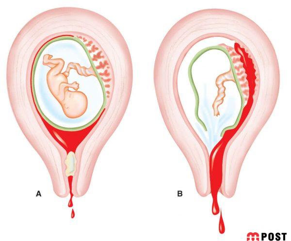 سقط مکرر و هر آنچه که باید درباره علل و راههای درمان آن بدانید 5 سقط مکرر