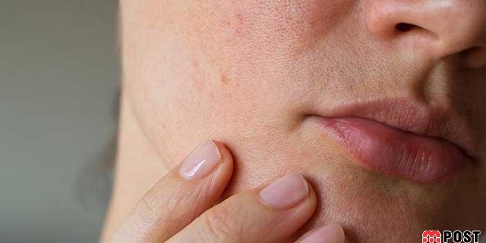 عواملی که مشکلات پوستی و منافذ باز پوست را تشدید می کند 10 مشکلات پوستی