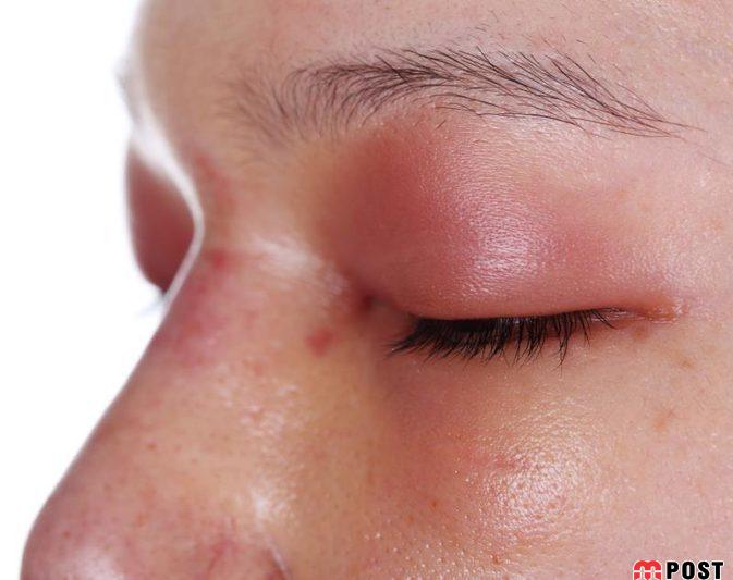 درمان عفونت چشم با استفاده از روش های خانگی موثر 4 درمان عفونت چشم