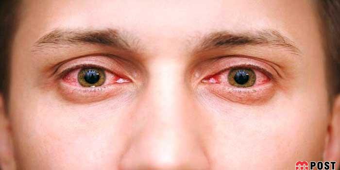 درمان عفونت چشم با استفاده از روش های خانگی موثر 5 درمان عفونت چشم