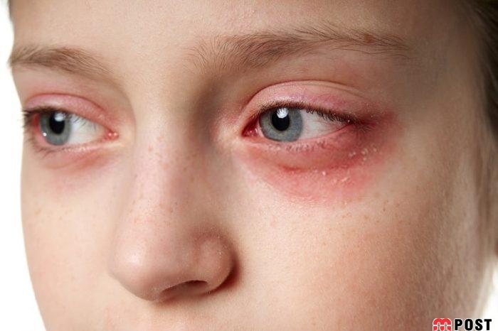 درمان عفونت چشم با استفاده از روش های خانگی موثر 3 درمان عفونت چشم