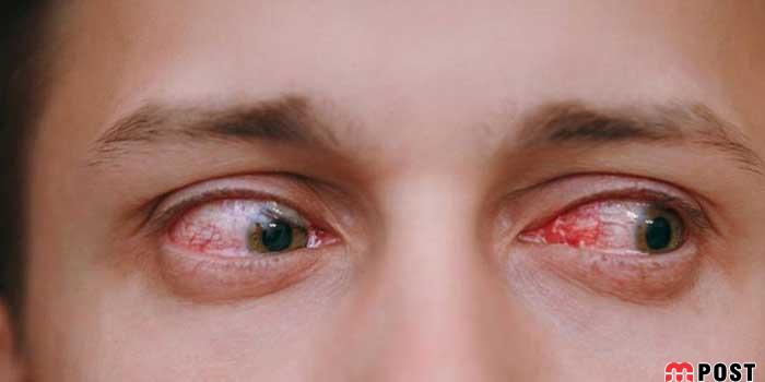 درمان قرمزی چشم با استفاده از چند ترفند کاربردی و موثر 2 درمان قرمزی چشم