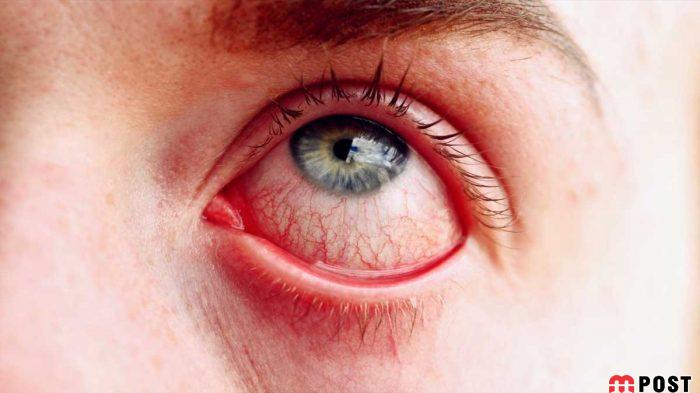 درمان قرمزی چشم با استفاده از چند ترفند کاربردی و موثر 3 درمان قرمزی چشم