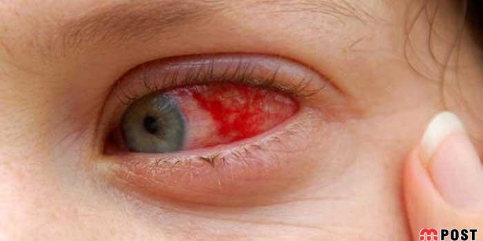 درمان قرمزی چشم