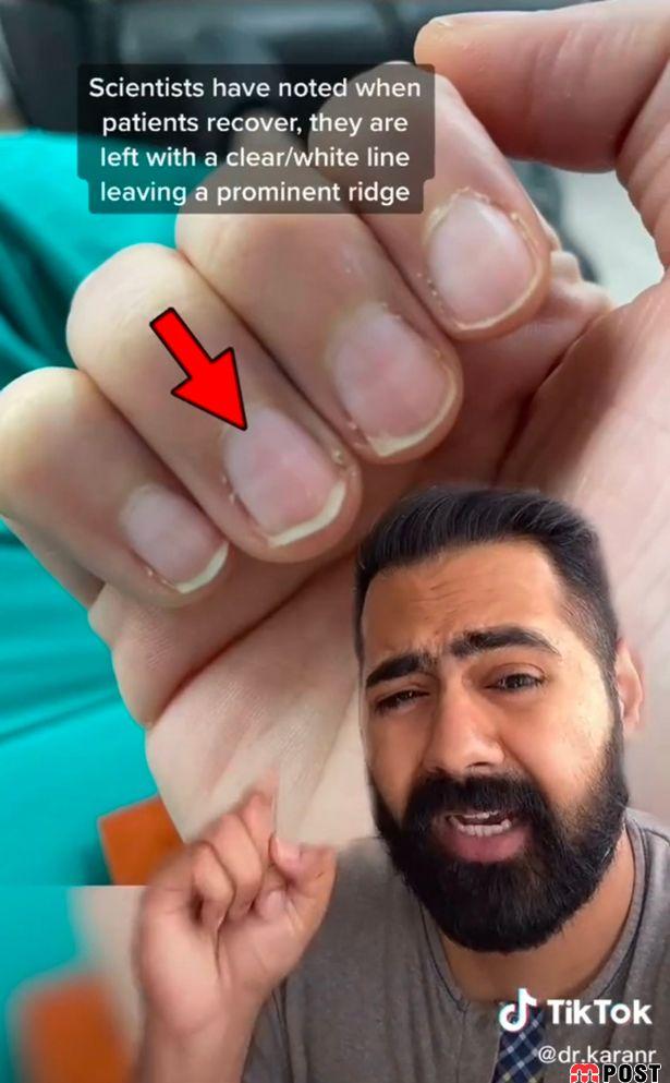 ادعای یک پزشک درباره تشخیص کرونا از روی ناخن ها 2 تشخیص کرونا