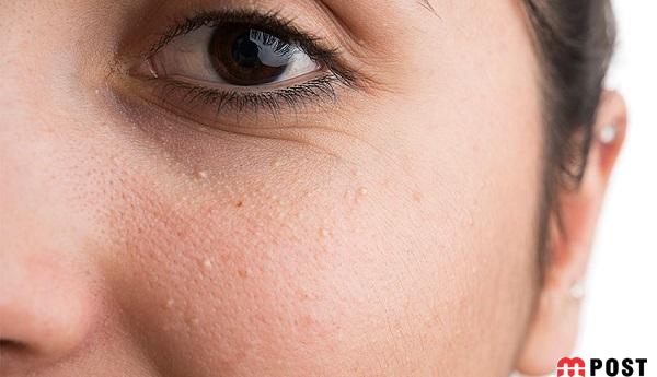 راه های درمان میلیا و هر آنچه که باید درباره این مساله پوستی بدانید 4 راه های درمان میلیا