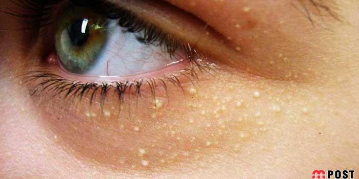 راه های درمان میلیا و هر آنچه که باید درباره این مساله پوستی بدانید 9 راه های درمان میلیا