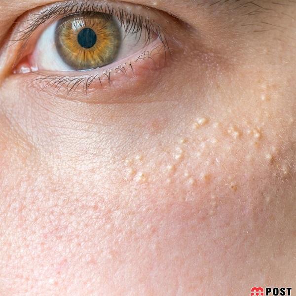 راه های درمان میلیا و هر آنچه که باید درباره این مساله پوستی بدانید 2 راه های درمان میلیا