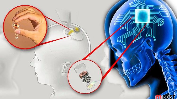 تراشه نورالینک Neuralink chip