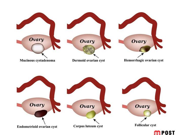 کیست هموراژیک تخمدان