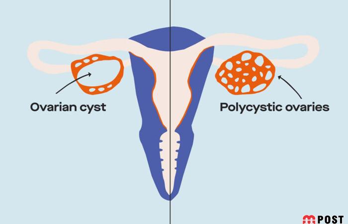 کیست هموراژیک تخمدان