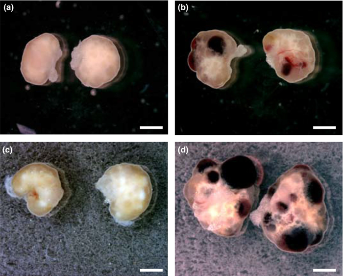 کیست هموراژیک تخمدان