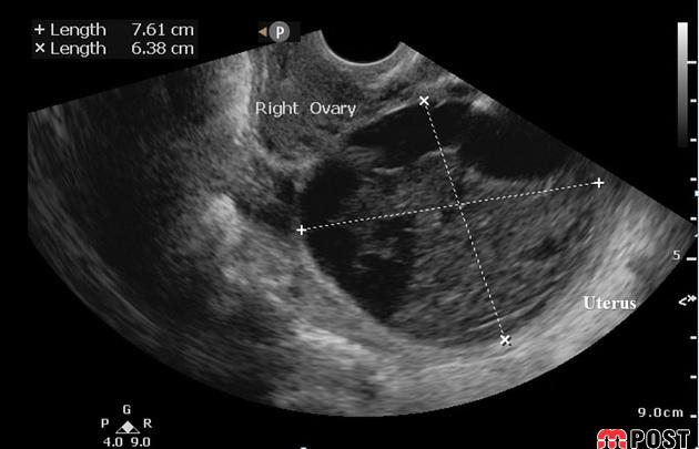 کیست هموراژیک تخمدان