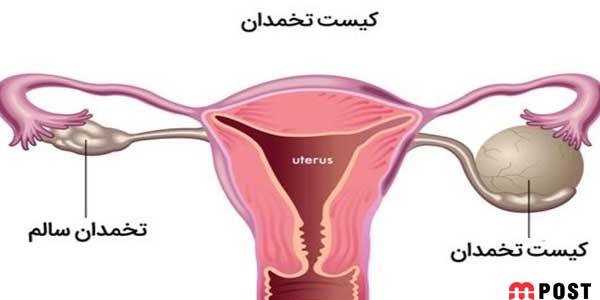 کیست هموراژیک تخمدان