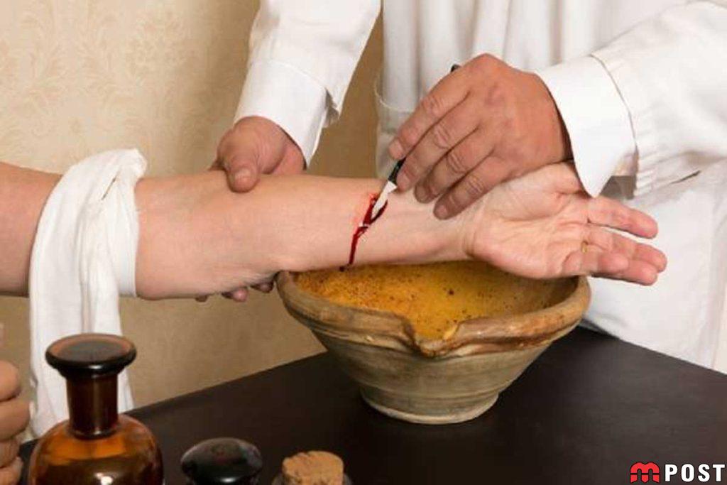 فصد خون چه فوایدی دارد و برای چه کسانی مناسب است؟ 2 فصد خون