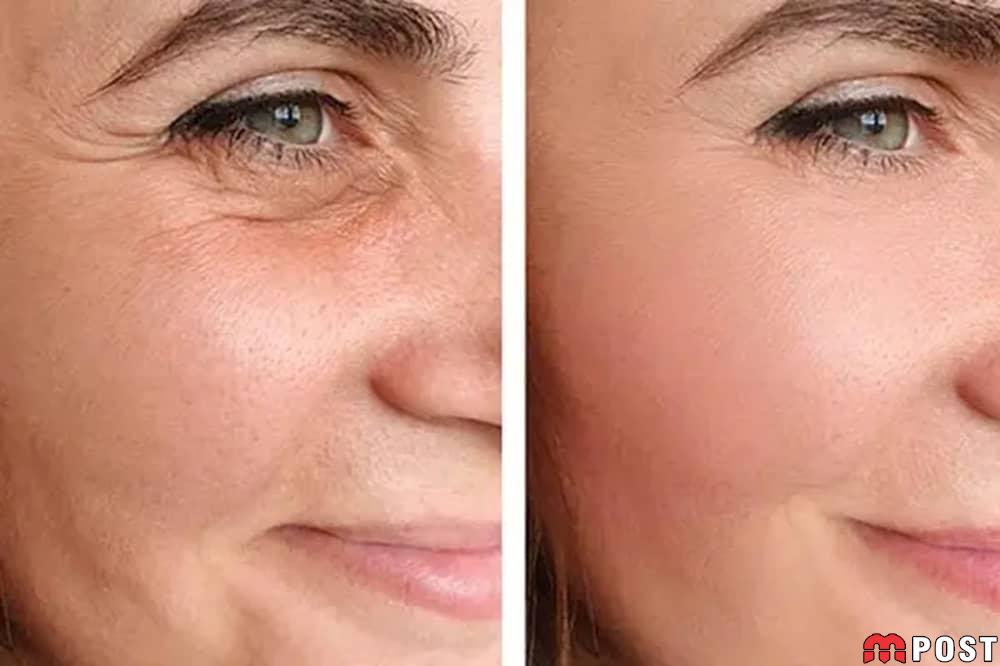 جوانسازی پوست صورت